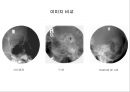 방사선사 국가고시 일반촬영 정리 (일반 영상검사, 일반 촬영, Lower extremity, Hip & pelvis, Spine, Mamo 촬영, 일반촬영 모의고사).ppt 17페이지