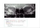 방사선사 국가고시 일반촬영 정리 (일반 영상검사, 일반 촬영, Lower extremity, Hip & pelvis, Spine, Mamo 촬영, 일반촬영 모의고사).ppt 23페이지