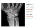 방사선사 국가고시 일반촬영 정리 (일반 영상검사, 일반 촬영, Lower extremity, Hip & pelvis, Spine, Mamo 촬영, 일반촬영 모의고사).ppt 29페이지