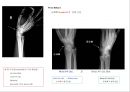 방사선사 국가고시 일반촬영 정리 (일반 영상검사, 일반 촬영, Lower extremity, Hip & pelvis, Spine, Mamo 촬영, 일반촬영 모의고사).ppt 31페이지