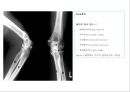 방사선사 국가고시 일반촬영 정리 (일반 영상검사, 일반 촬영, Lower extremity, Hip & pelvis, Spine, Mamo 촬영, 일반촬영 모의고사).ppt 35페이지