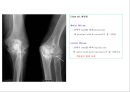 방사선사 국가고시 일반촬영 정리 (일반 영상검사, 일반 촬영, Lower extremity, Hip & pelvis, Spine, Mamo 촬영, 일반촬영 모의고사).ppt 36페이지