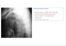 방사선사 국가고시 일반촬영 정리 (일반 영상검사, 일반 촬영, Lower extremity, Hip & pelvis, Spine, Mamo 촬영, 일반촬영 모의고사).ppt 39페이지
