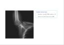 방사선사 국가고시 일반촬영 정리 (일반 영상검사, 일반 촬영, Lower extremity, Hip & pelvis, Spine, Mamo 촬영, 일반촬영 모의고사).ppt 42페이지