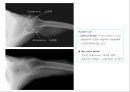 방사선사 국가고시 일반촬영 정리 (일반 영상검사, 일반 촬영, Lower extremity, Hip & pelvis, Spine, Mamo 촬영, 일반촬영 모의고사).ppt 43페이지