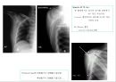 방사선사 국가고시 일반촬영 정리 (일반 영상검사, 일반 촬영, Lower extremity, Hip & pelvis, Spine, Mamo 촬영, 일반촬영 모의고사).ppt 46페이지