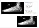 방사선사 국가고시 일반촬영 정리 (일반 영상검사, 일반 촬영, Lower extremity, Hip & pelvis, Spine, Mamo 촬영, 일반촬영 모의고사).ppt 51페이지