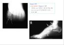 방사선사 국가고시 일반촬영 정리 (일반 영상검사, 일반 촬영, Lower extremity, Hip & pelvis, Spine, Mamo 촬영, 일반촬영 모의고사).ppt 52페이지