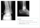 방사선사 국가고시 일반촬영 정리 (일반 영상검사, 일반 촬영, Lower extremity, Hip & pelvis, Spine, Mamo 촬영, 일반촬영 모의고사).ppt 55페이지