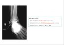 방사선사 국가고시 일반촬영 정리 (일반 영상검사, 일반 촬영, Lower extremity, Hip & pelvis, Spine, Mamo 촬영, 일반촬영 모의고사).ppt 56페이지