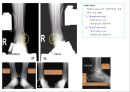 방사선사 국가고시 일반촬영 정리 (일반 영상검사, 일반 촬영, Lower extremity, Hip & pelvis, Spine, Mamo 촬영, 일반촬영 모의고사).ppt 57페이지
