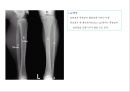 방사선사 국가고시 일반촬영 정리 (일반 영상검사, 일반 촬영, Lower extremity, Hip & pelvis, Spine, Mamo 촬영, 일반촬영 모의고사).ppt 58페이지
