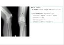 방사선사 국가고시 일반촬영 정리 (일반 영상검사, 일반 촬영, Lower extremity, Hip & pelvis, Spine, Mamo 촬영, 일반촬영 모의고사).ppt 59페이지