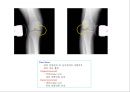 방사선사 국가고시 일반촬영 정리 (일반 영상검사, 일반 촬영, Lower extremity, Hip & pelvis, Spine, Mamo 촬영, 일반촬영 모의고사).ppt 63페이지