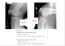 방사선사 국가고시 일반촬영 정리 (일반 영상검사, 일반 촬영, Lower extremity, Hip & pelvis, Spine, Mamo 촬영, 일반촬영 모의고사).ppt 64페이지