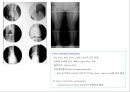 방사선사 국가고시 일반촬영 정리 (일반 영상검사, 일반 촬영, Lower extremity, Hip & pelvis, Spine, Mamo 촬영, 일반촬영 모의고사).ppt 67페이지