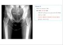 방사선사 국가고시 일반촬영 정리 (일반 영상검사, 일반 촬영, Lower extremity, Hip & pelvis, Spine, Mamo 촬영, 일반촬영 모의고사).ppt 69페이지