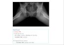 방사선사 국가고시 일반촬영 정리 (일반 영상검사, 일반 촬영, Lower extremity, Hip & pelvis, Spine, Mamo 촬영, 일반촬영 모의고사).ppt 70페이지