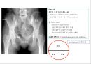 방사선사 국가고시 일반촬영 정리 (일반 영상검사, 일반 촬영, Lower extremity, Hip & pelvis, Spine, Mamo 촬영, 일반촬영 모의고사).ppt 73페이지