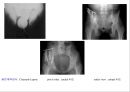 방사선사 국가고시 일반촬영 정리 (일반 영상검사, 일반 촬영, Lower extremity, Hip & pelvis, Spine, Mamo 촬영, 일반촬영 모의고사).ppt 74페이지