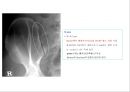 방사선사 국가고시 일반촬영 정리 (일반 영상검사, 일반 촬영, Lower extremity, Hip & pelvis, Spine, Mamo 촬영, 일반촬영 모의고사).ppt 76페이지