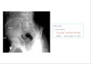 방사선사 국가고시 일반촬영 정리 (일반 영상검사, 일반 촬영, Lower extremity, Hip & pelvis, Spine, Mamo 촬영, 일반촬영 모의고사).ppt 77페이지