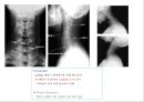방사선사 국가고시 일반촬영 정리 (일반 영상검사, 일반 촬영, Lower extremity, Hip & pelvis, Spine, Mamo 촬영, 일반촬영 모의고사).ppt 79페이지