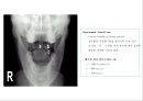 방사선사 국가고시 일반촬영 정리 (일반 영상검사, 일반 촬영, Lower extremity, Hip & pelvis, Spine, Mamo 촬영, 일반촬영 모의고사).ppt 81페이지