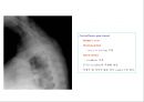 방사선사 국가고시 일반촬영 정리 (일반 영상검사, 일반 촬영, Lower extremity, Hip & pelvis, Spine, Mamo 촬영, 일반촬영 모의고사).ppt 82페이지