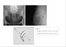 방사선사 국가고시 일반촬영 정리 (일반 영상검사, 일반 촬영, Lower extremity, Hip & pelvis, Spine, Mamo 촬영, 일반촬영 모의고사).ppt 88페이지