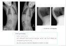 방사선사 국가고시 일반촬영 정리 (일반 영상검사, 일반 촬영, Lower extremity, Hip & pelvis, Spine, Mamo 촬영, 일반촬영 모의고사).ppt 91페이지