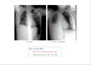 방사선사 국가고시 일반촬영 정리 (일반 영상검사, 일반 촬영, Lower extremity, Hip & pelvis, Spine, Mamo 촬영, 일반촬영 모의고사).ppt 94페이지