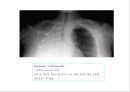 방사선사 국가고시 일반촬영 정리 (일반 영상검사, 일반 촬영, Lower extremity, Hip & pelvis, Spine, Mamo 촬영, 일반촬영 모의고사).ppt 95페이지