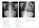 방사선사 국가고시 일반촬영 정리 (일반 영상검사, 일반 촬영, Lower extremity, Hip & pelvis, Spine, Mamo 촬영, 일반촬영 모의고사).ppt 96페이지