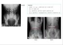 방사선사 국가고시 일반촬영 정리 (일반 영상검사, 일반 촬영, Lower extremity, Hip & pelvis, Spine, Mamo 촬영, 일반촬영 모의고사).ppt 98페이지