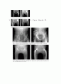 고관절 반치환술 (Bipolar Hemiarthroplasty) & 전치환술 (THR)

 16페이지