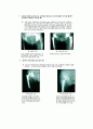 고관절 반치환술 (Bipolar Hemiarthroplasty) & 전치환술 (THR)

 19페이지