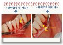 비외과적 & 외과적 치주치료 {Scaling, Root planing, 치주수술의 개요 및 일반원칙, 치은연하 소파술, 치은절제술과 치은성형술}.pptx
 24페이지