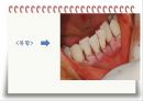 비외과적 & 외과적 치주치료 {Scaling, Root planing, 치주수술의 개요 및 일반원칙, 치은연하 소파술, 치은절제술과 치은성형술}.pptx
 26페이지