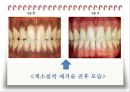 비외과적 & 외과적 치주치료 {Scaling, Root planing, 치주수술의 개요 및 일반원칙, 치은연하 소파술, 치은절제술과 치은성형술}.pptx
 30페이지
