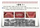 비외과적 & 외과적 치주치료 {Scaling, Root planing, 치주수술의 개요 및 일반원칙, 치은연하 소파술, 치은절제술과 치은성형술}.pptx
 37페이지