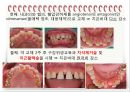 비외과적 & 외과적 치주치료 {Scaling, Root planing, 치주수술의 개요 및 일반원칙, 치은연하 소파술, 치은절제술과 치은성형술}.pptx
 38페이지