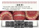 비외과적 & 외과적 치주치료 {Scaling, Root planing, 치주수술의 개요 및 일반원칙, 치은연하 소파술, 치은절제술과 치은성형술}.pptx
 41페이지