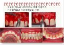 비외과적 & 외과적 치주치료 {Scaling, Root planing, 치주수술의 개요 및 일반원칙, 치은연하 소파술, 치은절제술과 치은성형술}.pptx
 43페이지