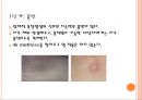 욕창간호 {정의, 발생원인, 위험요인, 발생부위, 발생단계, 치료, 간호와 예방}.pptx 22페이지