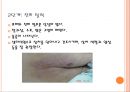 욕창간호 {정의, 발생원인, 위험요인, 발생부위, 발생단계, 치료, 간호와 예방}.pptx 24페이지