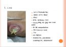 욕창간호 {정의, 발생원인, 위험요인, 발생부위, 발생단계, 치료, 간호와 예방}.pptx 36페이지