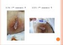 욕창간호 {정의, 발생원인, 위험요인, 발생부위, 발생단계, 치료, 간호와 예방}.pptx 38페이지