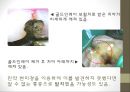 근관치료 장비 및 재료 & 니켈티타늄 전동파일의 파절과 임상적 예후.pptx 7페이지