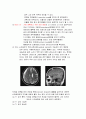 만성 경막하 출혈 (Chronic Subdural Hemorrhage) 케이스 스터디 CASE STUDY - 수술명 : burr hole trephination and SDH removal 4페이지